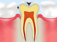 【エナメル質のむし歯】