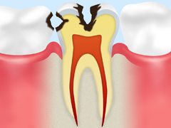 【象牙質のむし歯】