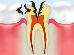 【神経にまで達したむし歯】