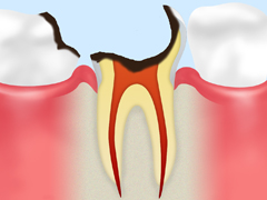 【歯根にまで達したむし歯】