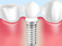 インプラント治療