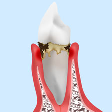 【中等度歯周炎】