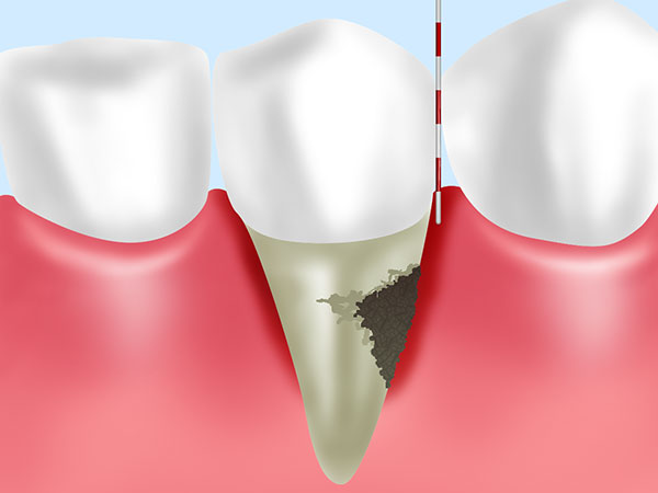 歯周ポケット検査