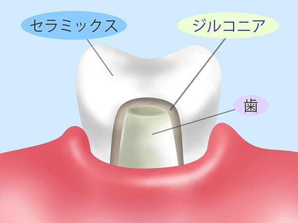 金属アレルギーの心配がありません